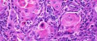 cancerous oral tissue